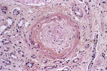 Case Study and Clinical Highlight: Diagnosis of Pulmonary Involvement in Systemic Sclerosis Case Study and Clinical Highlight: Diagnosis of Pulmonary Involvement in Systemic Sclerosis