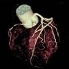 Approach to Coronary Artery Disease in the Patient With Rheumatoid Arthritis Approach to Coronary Artery Disease in the Patient With Rheumatoid Arthritis