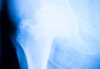 Preop PsA Not an Independent Predictor of Postop Pain or Function After THA Preop PsA Not an Independent Predictor of Postop Pain or Function After THA