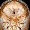 Rheumatoid Arthritis and Associated Neurologic Manifestations Rheumatoid Arthritis and Associated Neurologic Manifestations