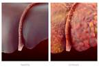 Association of MTX and Liver Cirrhosis in Patients with Concomittant RA and HBV Infection Association of MTX and Liver Cirrhosis in Patients with Concomittant RA and HBV Infection