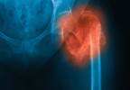 Teriparatide More Effective Than Risedronate in Osteoporotic Fractures Teriparatide More Effective Than Risedronate in Osteoporotic Fractures