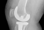 Venous Thromboembolism Prevention After Joint Arthroplasty With Rivaroxaban or Aspirin Venous Thromboembolism Prevention After Joint Arthroplasty With Rivaroxaban or Aspirin