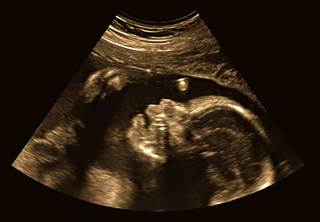 Women with juvenile idiopathic arthritis experienced low but stable disease activity during and after pregnancy. Women with juvenile idiopathic arthritis experienced low but stable disease activity during and after pregnancy.