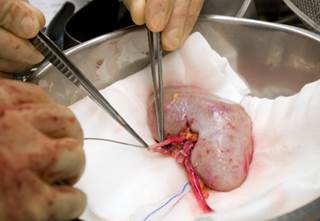 Methylene blue treatment of kidneys during cold ischemia time may reduce the risk for HCV transmission during transplantation. Methylene blue treatment of kidneys during cold ischemia time may reduce the risk for HCV transmission during transplantation.