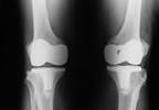 Effects of Peripheral Nerve Blocks on THA, TKA Outcomes Effects of Peripheral Nerve Blocks on THA, TKA Outcomes