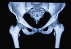 Can a Diet Reduce Hip Fractures in Postmenopausal Women? Can a Diet Reduce Hip Fractures in Postmenopausal Women?