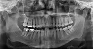 Intensive periodontal therapy can reduce blood pressure and improve endothelial function in prehypertensive patients. Intensive periodontal therapy can reduce blood pressure and improve endothelial function in prehypertensive patients.