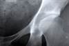 Antiretroviral Therapy Associated With Decreases in Bone Mineral Density Antiretroviral Therapy Associated With Decreases in Bone Mineral Density