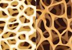 Zoledronate Lowers Fracture Risk in Women With Osteopenia Zoledronate Lowers Fracture Risk in Women With Osteopenia