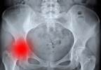 Prospective Study Identifies Dietary Deficiencies Associated With Hip Fracture Risk Prospective Study Identifies Dietary Deficiencies Associated With Hip Fracture Risk