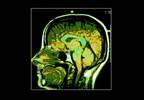 Peripheral Inflammatory Markers Are Associated With Psychomotor Retardation in Major Depressive Disorder Peripheral Inflammatory Markers Are Associated With Psychomotor Retardation in Major Depressive Disorder