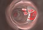 Ischemic Digital Ulcers Not Reduced by Endothelin-1 Blocker Macitentan in SSc Ischemic Digital Ulcers Not Reduced by Endothelin-1 Blocker Macitentan in SSc