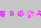 Proinflammatory Monocyte Phentoype Identified in FM Proinflammatory Monocyte Phentoype Identified in FM