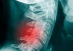 Diagnoses Associated With Inpatient Mortality in AS Diagnoses Associated With Inpatient Mortality in AS