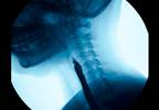 Autoantibodies Prognostic of Dysphagia in Dermatomyositis Autoantibodies Prognostic of Dysphagia in Dermatomyositis