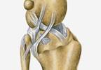 No Functional Improvement in Knee OA With Spironolactone No Functional Improvement in Knee OA With Spironolactone