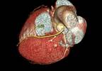 Increased CVD Risk in Middle Aged Men With Newly Diagnosed AS Increased CVD Risk in Middle Aged Men With Newly Diagnosed AS