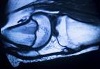 Can Markers of Cartilage Collagen Metabolism Aid in PsA and AxSpA Dx? Can Markers of Cartilage Collagen Metabolism Aid in PsA and AxSpA Dx?
