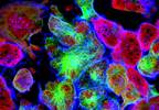 Improving Early Diagnosis of Paraneoplastic Rheumatic Diseases to Improve Outcomes Improving Early Diagnosis of Paraneoplastic Rheumatic Diseases to Improve Outcomes