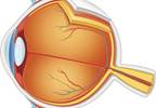 Adalimumab Gains FDA Approval for Noninfectious Uveitis Adalimumab Gains FDA Approval for Noninfectious Uveitis
