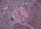 Complications of Biologic Response Modifier Use in Pediatric Patients Complications of Biologic Response Modifier Use in Pediatric Patients
