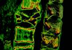 Sclerostin Inhibitor Romosozumab Reduces Fracture Risk Postmenopause Sclerostin Inhibitor Romosozumab Reduces Fracture Risk Postmenopause