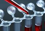 Antineutrophil Cytoplasmic Antibody-Associated Vasculitis Biomarkers Identified Antineutrophil Cytoplasmic Antibody-Associated Vasculitis Biomarkers Identified