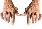 Dose-Dependent ACR20 Response Rates in RA With Peficitinib Dose-Dependent ACR20 Response Rates in RA With Peficitinib