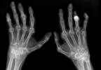 BLA Submitted for RA Investigational IL-6 Monoclonal Antibody BLA Submitted for RA Investigational IL-6 Monoclonal Antibody
