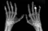 Tapering DMARD Therapy in Rheumatoid Arthritis Tapering DMARD Therapy in Rheumatoid Arthritis