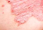 Efficacy of IL-6 Inhibition in csDMARD-Inadequate Responders With PsA Efficacy of IL-6 Inhibition in csDMARD-Inadequate Responders With PsA