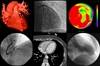 Autoimmune Inflammatory Disorders Associated With CVD Morbidity Autoimmune Inflammatory Disorders Associated With CVD Morbidity