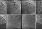Effects of Colchicine Use on CVD, Mortality in Gout Effects of Colchicine Use on CVD, Mortality in Gout