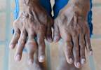 Uncontrolled Gout: Duzallo Now Available Uncontrolled Gout: Duzallo Now Available