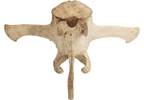 FDA Approves Intraosseous Nerve Ablation for Axial Back Pain FDA Approves Intraosseous Nerve Ablation for Axial Back Pain