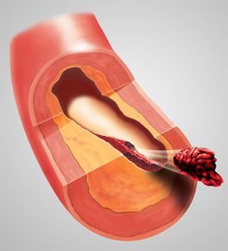 Pharmacologic prophylaxis should be considered unless an absolute contraindication exists. Pharmacologic prophylaxis should be considered unless an absolute contraindication exists.