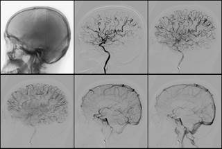 The cerebrovascular events reported most often in patients with systemic lupus erythematosus include stroke and transient ischemia. The cerebrovascular events reported most often in patients with systemic lupus erythematosus include stroke and transient ischemia.