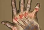 Secukinumab Improves Symptoms in TNFi-Refractory Rheumatoid Arthritis Secukinumab Improves Symptoms in TNFi-Refractory Rheumatoid Arthritis