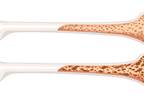 Denosumab vs Risendronate for GC-Induced Osteoporosis Denosumab vs Risendronate for GC-Induced Osteoporosis
