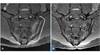 Revisiting Juvenile Spondyloarthritis Revisiting Juvenile Spondyloarthritis