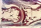 Rheumatoid Arthritis Treatment Initiated Early on Shows Good Long-Term Outcomes Rheumatoid Arthritis Treatment Initiated Early on Shows Good Long-Term Outcomes