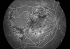 Systemic Therapy Associated With Improved Visual Acuity in Uveitis Systemic Therapy Associated With Improved Visual Acuity in Uveitis