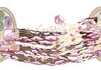 Polyneuropathy May Signify More Severe Parkinson's Disease Polyneuropathy May Signify More Severe Parkinson's Disease
