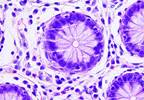 Comparative Malignancy Risks in AS vs General Population Comparative Malignancy Risks in AS vs General Population