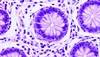 TNFi Not Linked to Increased Risk for Cancer Recurrence in Rheumatoid Arthritis TNFi Not Linked to Increased Risk for Cancer Recurrence in Rheumatoid Arthritis