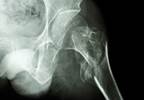 Evenity Reduces Risk of New Fractures in Postmenopausal Women With Osteoperosis Evenity Reduces Risk of New Fractures in Postmenopausal Women With Osteoperosis