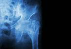 Meta-analysis Quantifies Fracture Risk Reduction With Calcium, Vit D Meta-analysis Quantifies Fracture Risk Reduction With Calcium, Vit D