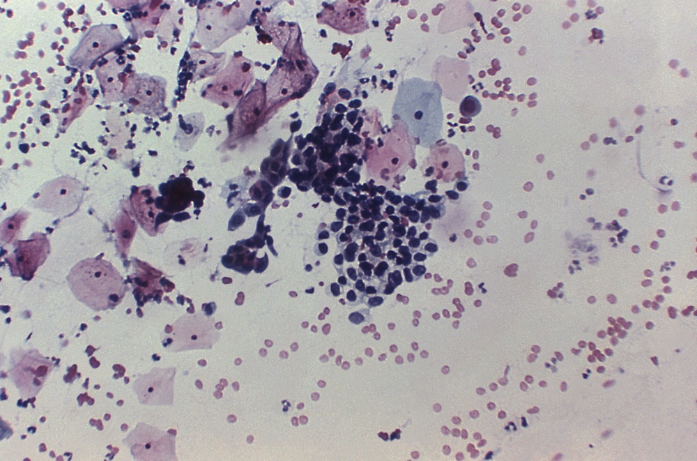 Comparative Risk Of Cervical Dysplasia With Bdmards Vs