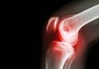 Examining the Relationship Between Weight Loss and Knee Degeneration Examining the Relationship Between Weight Loss and Knee Degeneration
